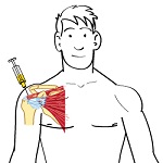 Injecting Corticosteroids