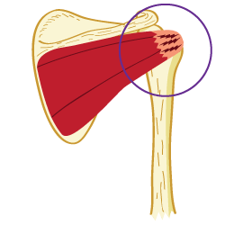 Infraspinatus Tendonitis